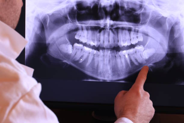 Best Knocked-Out Tooth (Avulsed Tooth) Treatment in The Meadows, FL